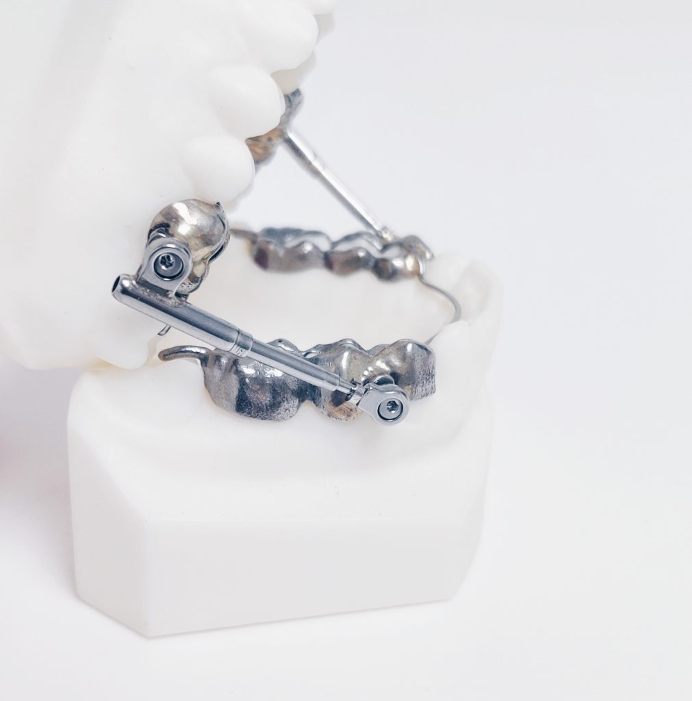 Soorten beugels Orthodontie Lisse