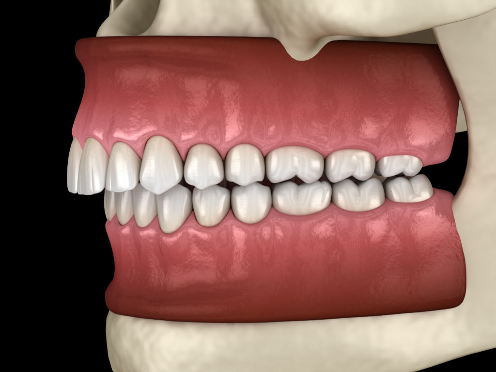 Orthodontie Lisse | Wanneer moet beugel ?